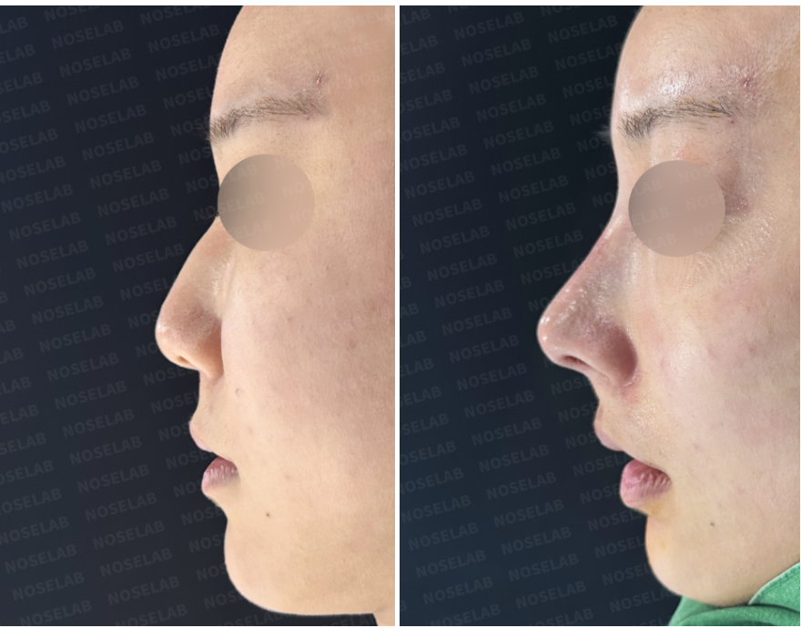 Before and immediately after surgery lateral view showing correction of a dorsal hump and elevation of a drooping nasal tip after nasal filler removal and closed rhinoplasty using autologous rib cartilage.