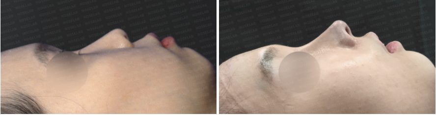 Short nose rhinoplasty – before and after comparison side view (left before, right after)