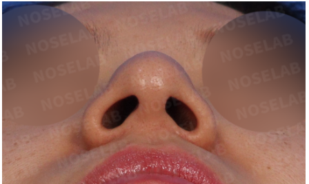 Preoperative nostril view showing wide nostrils and unclear alar cartilage shape before revision rhinoplasty in Korea