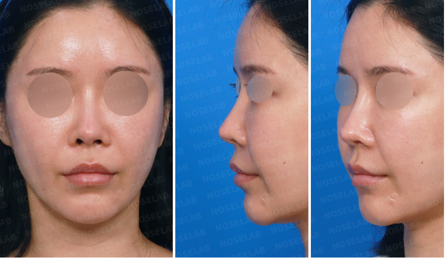 Preoperative views for Reconstructive Revision Rhinoplasty Korea showing frontal and side angles.