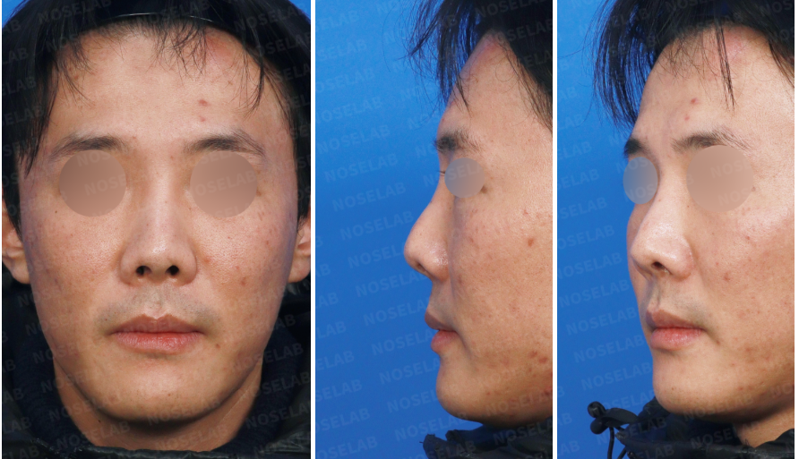 Preoperative facial views before closed rhinoplasty Korea, showing frontal, left oblique, and left side profile in a patient with nasal asymmetry and contracted nose prior to revision surgery.