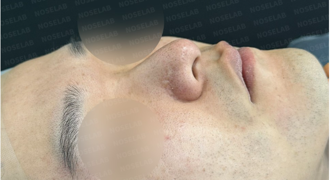 Before surgery – 45-degree view showing droopy nasal tip and bulbous nose shape (Noselab Clinic)