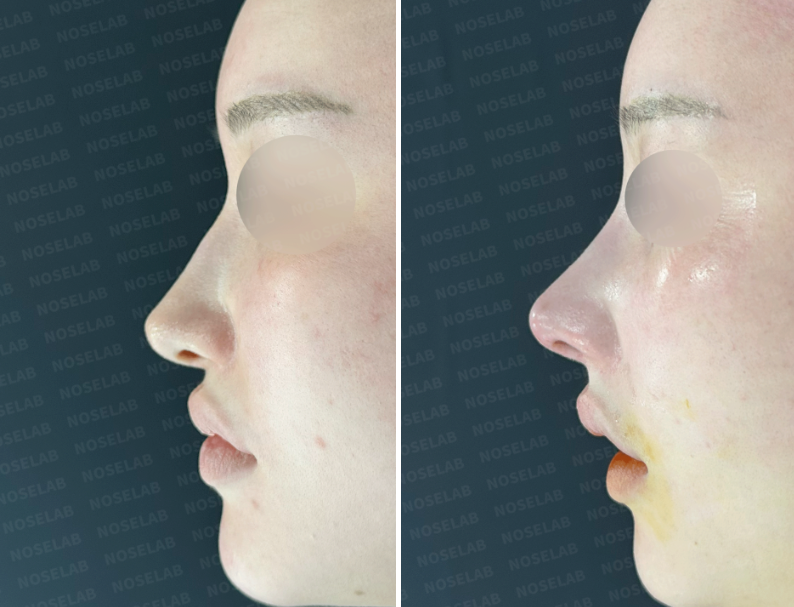 Before and immediately after no-implant nose surgery using autologous rib cartilage: Profile view showing improved nasal height and swelling.