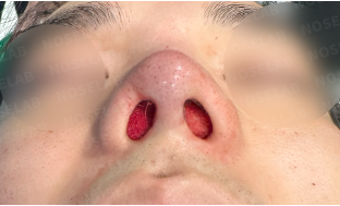 Enhancing nasal height & resolving nasal obstruction – immediate post-surgery nostril view photo of patient at Nose Lab Clinic.