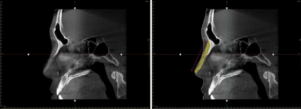 CT scan images showing a silicone implant extending to the nasal tip. The right image highlights the silicone implant in yellow.