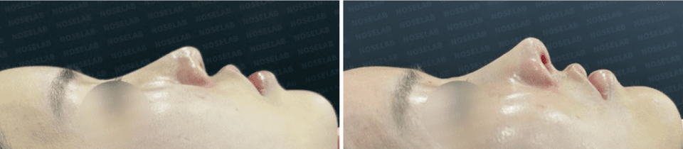 Photos were taken immediately before and after the surgery with the consent of the patient. 