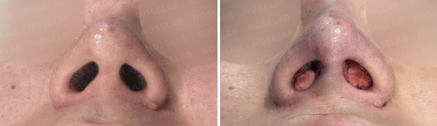 Before and immediately after nostril view following closed rhinoplasty Korea for high nose correction, showing improved nostril symmetry, reduced nostril show, and stable tip support achieved with autologous rib cartilage.