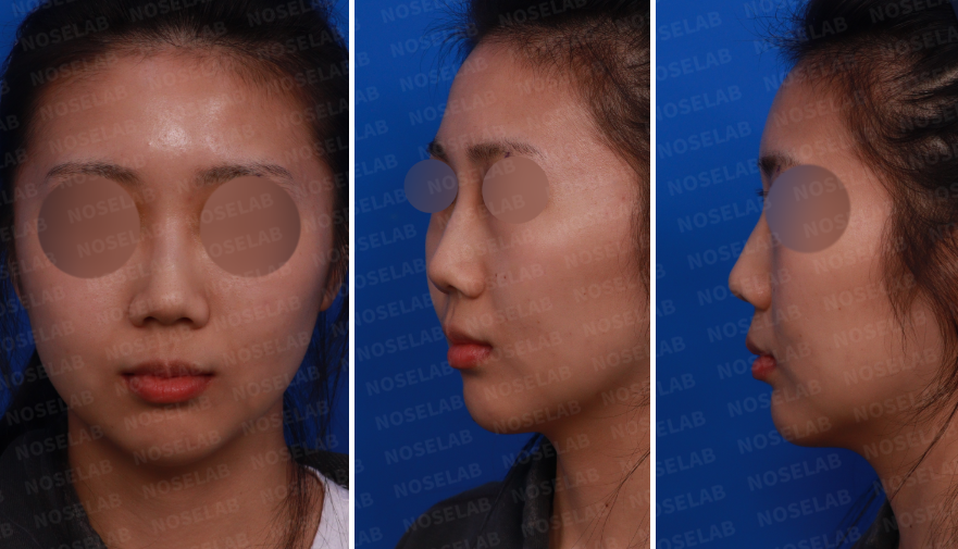Preoperative design consultation photos showing the patient’s frontal view, left oblique side view, and left side view before closed rhinoplasty.