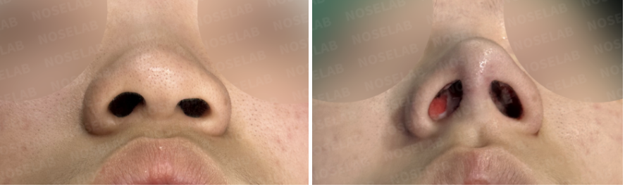 Before and immediately after surgery basal view showing narrowed nasal tip, improved nostril symmetry, and refined nasal base following closed rhinoplasty with rib cartilage septal extension.