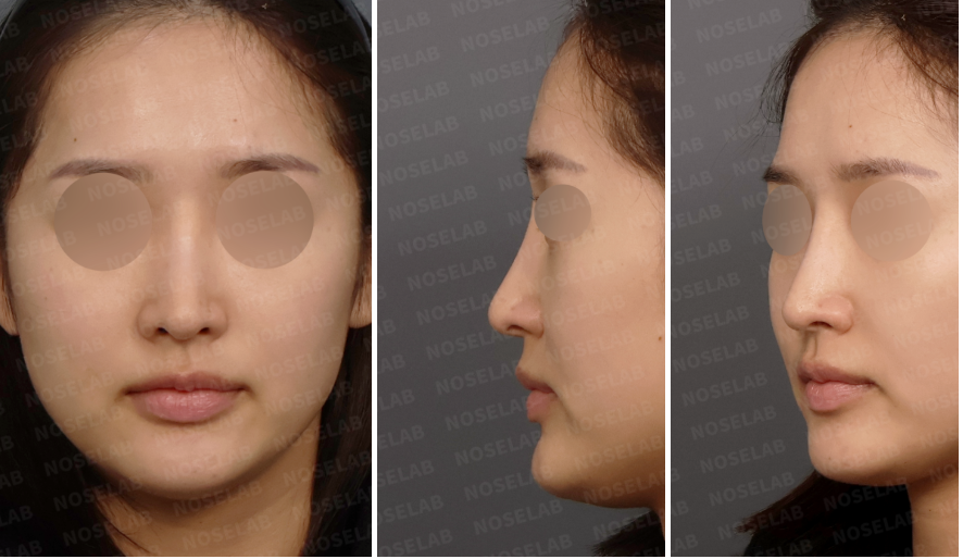 Preoperative design consultation photos showing frontal view, left oblique side view, and left side profile of a female revision rhinoplasty patient with a long-looking nose and drooping nasal tip.