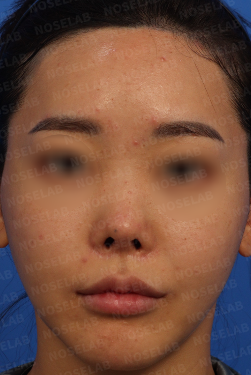 Preoperative frontal view – contractured nose with asymmetry and visible nostril exposure | Contractured Nose Correction