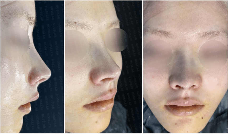 Photos after the surgery. 90° angle | 45° angle | Frontal view