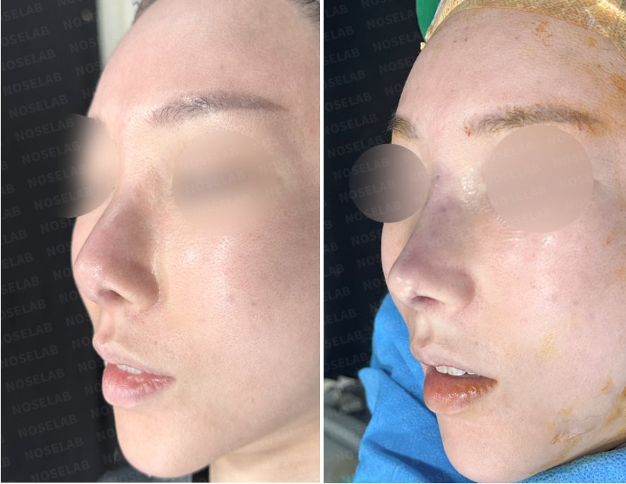 Oblique side view before (left) and immediately after (right) revision rhinoplasty for severe nasal contracture – restored nasal tip projection and smoother dorsal line.