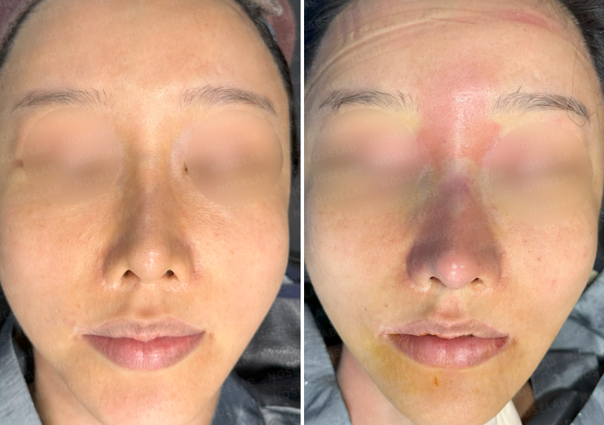 Rhinoplasty for long mid-face correction – before (left) and after (right) frontal view photos