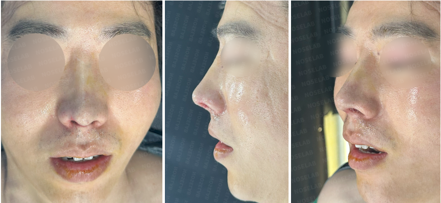 Immediately after surgery: Frontal, side, and oblique side view photos showing improved nasal tip projection and nostril symmetry