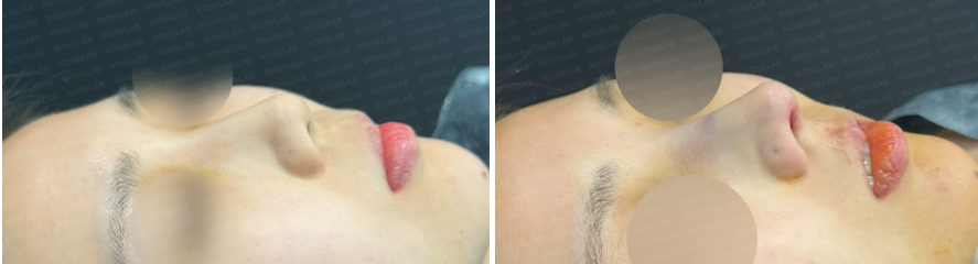 Before and immediately after closed rhinoplasty: oblique side view comparison showing refined nasal tip and improved profile balance.