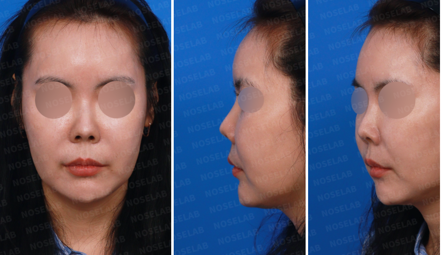 Preoperative consultation photos before L-shaped silicone implant removal, showing frontal, left oblique, and side views of the patient’s nose.