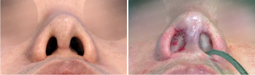 Before and immediately after Revision Rhinoplasty for Nasal Asymmetry and Nostril Correction – nostril view comparison showing improved nostril symmetry, reduced columella retraction, and corrected pinched appearance.
