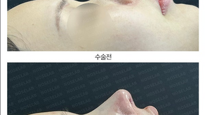 Nasal contracture reoperation using self-rib cartilage – revision rhinoplasty Korea