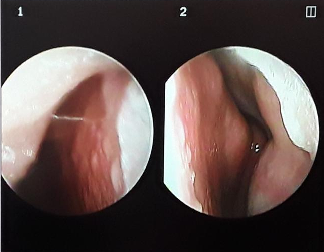 Nasal endoscopy images of the right (1) and left (2) nasal cavity showing septal deviation and inferior turbinate hypertrophy.