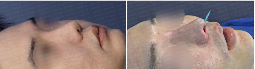 efore and immediately after Revision Rhinoplasty for Nasal Asymmetry and Nostril Correction – oblique side view comparison showing straighter nasal bridge, improved nostril balance, and refined columella position.