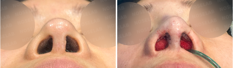 Comparison of before and immediately after closed short nose revision in Korea: Nostril view.