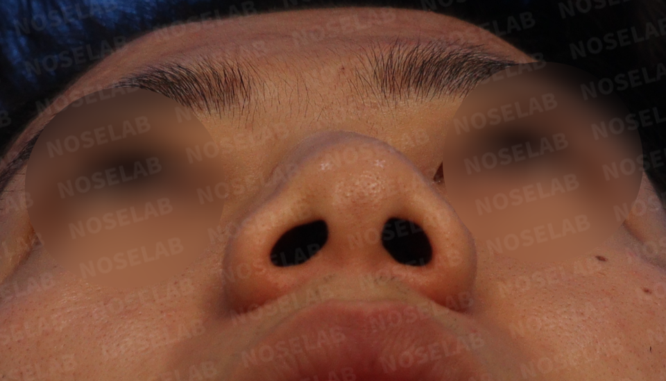 Nostril view of Asian male patient before Closed Rhinoplasty Korea, showing nostril asymmetry and wide blunt nasal tip.