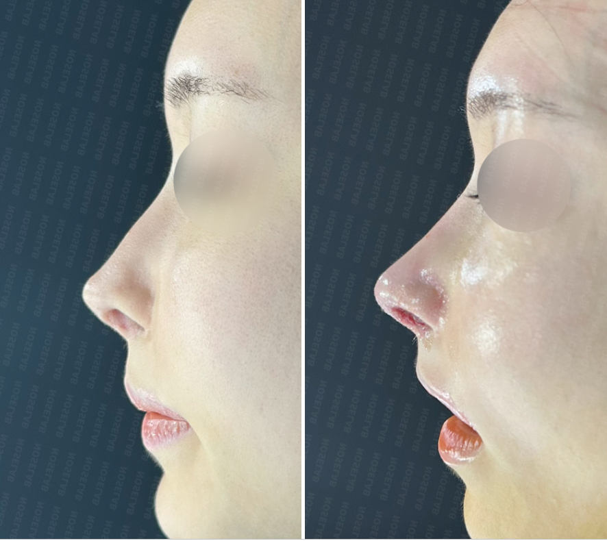 Before (left) and immediately after (right) customized rhinoplasty for cartilage visibility – side profile showing softened nasal tip, elimination of cartilage show-through, and maintained dorsal height.