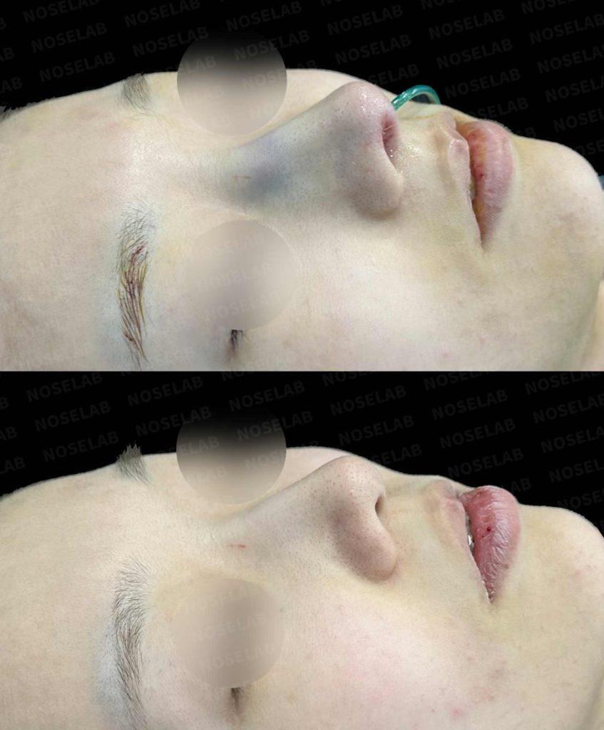 45-degree angle before and after closed rhinoplasty showing improved nasal line and symmetry after deviated nose correction with self-rib cartilage (Noselab Clinic)