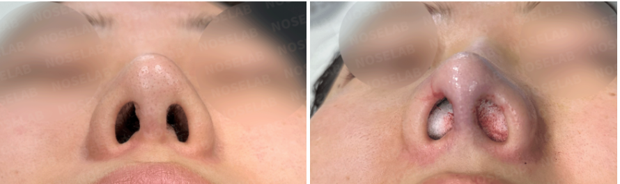 Nostril view before and immediately after customized nasal reconstruction – corrected asymmetry, reduced scar tissue, and improved columella alignment