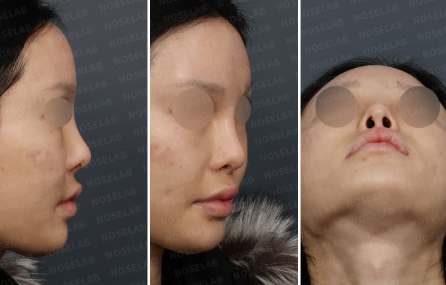 Preoperative design consultation photos showing high radix, deviated nasal bridge, and nostril asymmetry from right lateral, right oblique, and basal views.