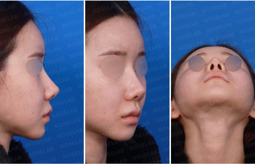 Columella Extension Rhinoplasty Korea preoperative right side and nostril views of elevated tip