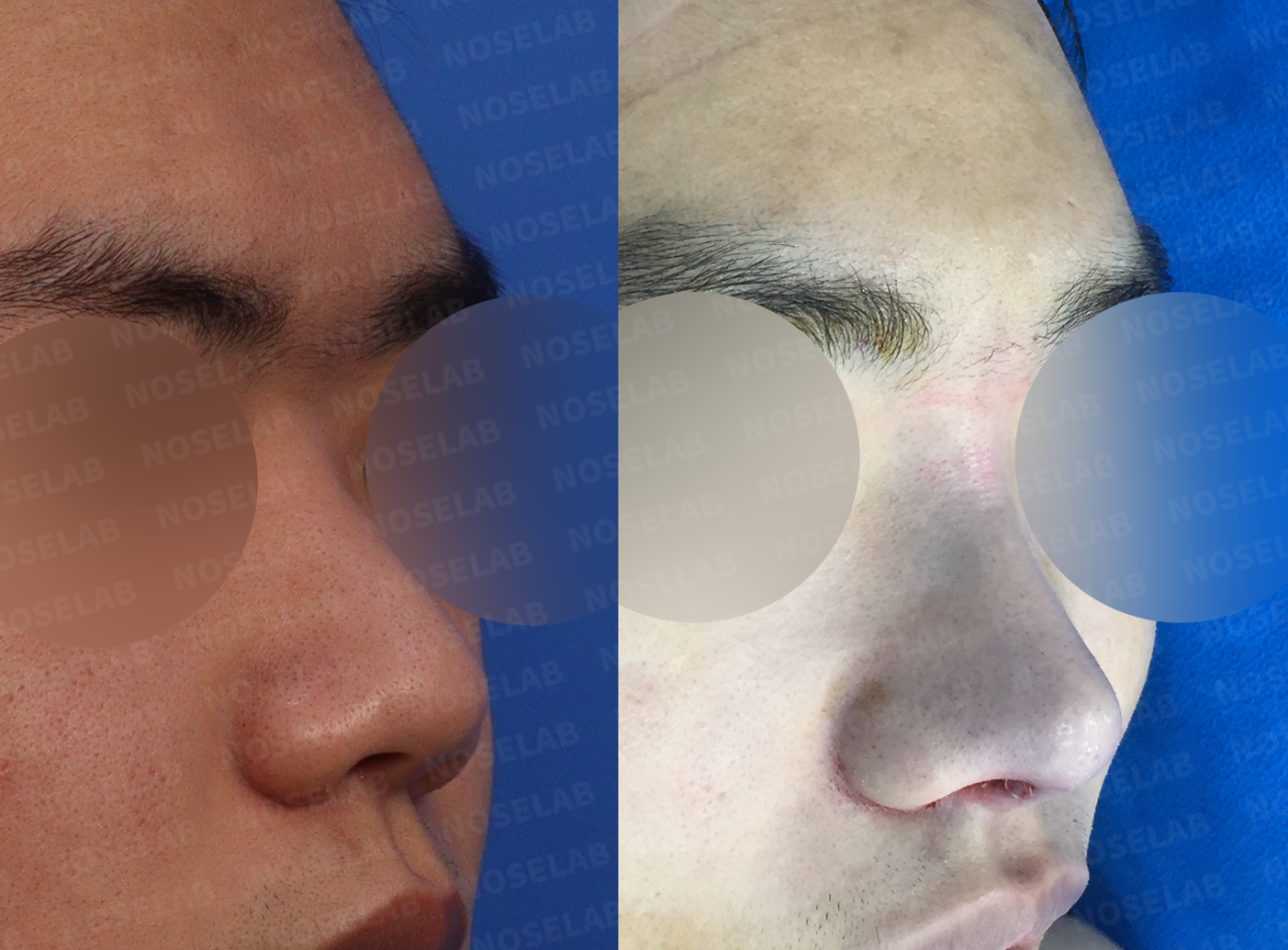 Three-quarter angle view demonstrating refined nasal tip contour and improved projection