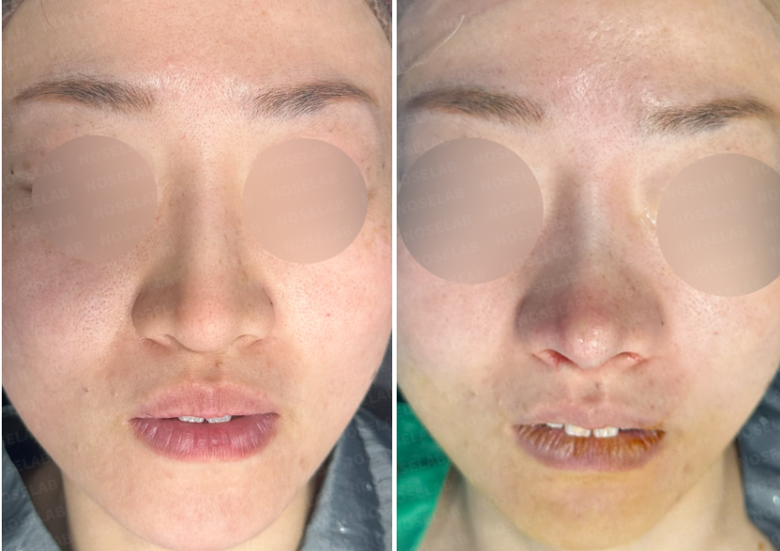 Frontal view comparison of the patient before (left) and immediately after (right) revision rhinoplasty showing correction of bulbous tip and nostril asymmetry.