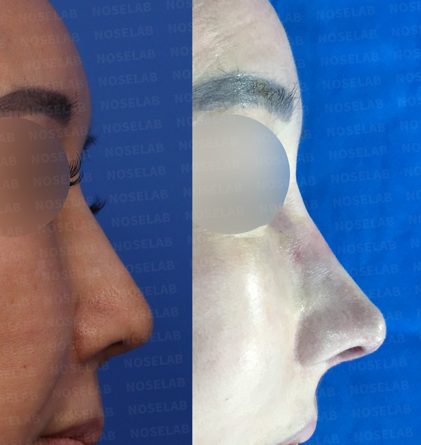 Side-by-side comparison demonstrating rhinoplasty outcomes with improved nasal profile and refined tip definition