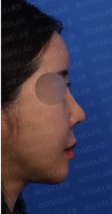 Revision rhinoplasty Korea – preoperative side profile view of upturned and deviated nose
