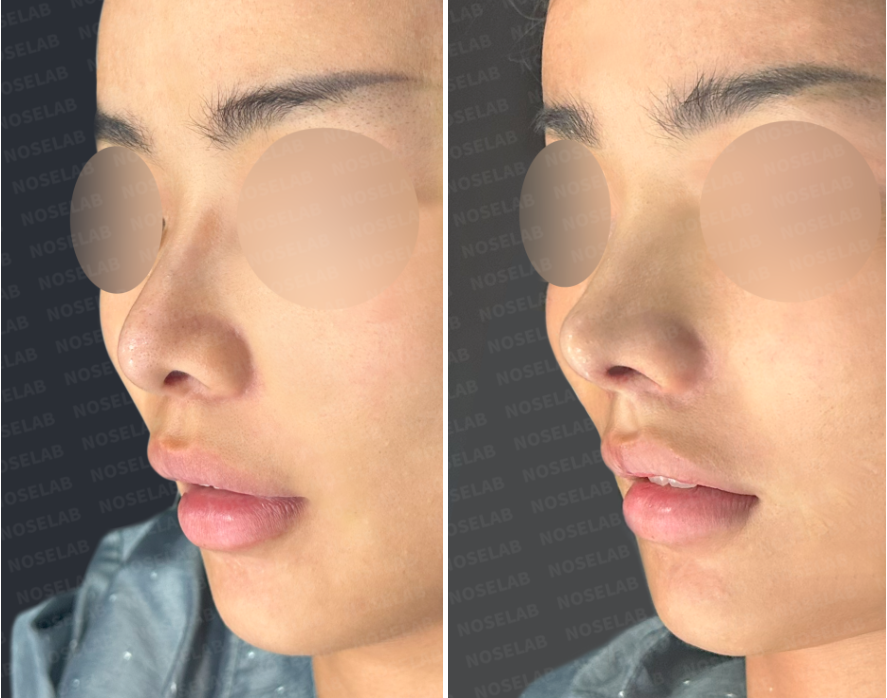 Before and immediately after droopy nasal tip correction, oblique side view showing elevated nasal tip, improved contour, and natural refinement of the nose.