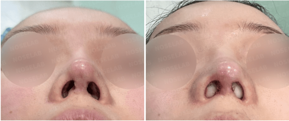 Photos were taken immediately before and after the surgery with the consent of the patient.