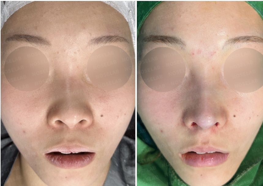 Before and immediately after surgery frontal view showing improved nasal bridge height and refined nasal tip following closed rhinoplasty using donor rib cartilage and a silicone implant.