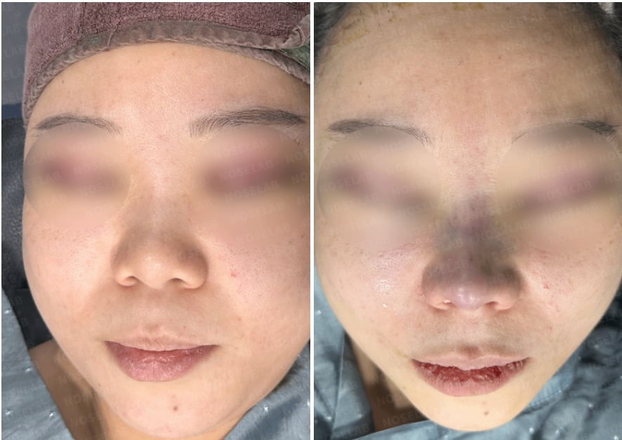 Short Nose Correction – Before (left) and immediately after surgery (right) frontal view photos showing improved nasal length, refined tip, and natural columella projection after closed rhinoplasty.