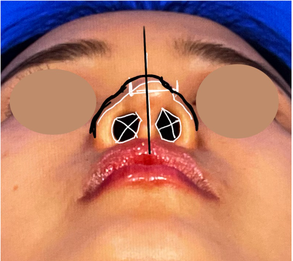 Nostril view photo before nasal mucosal adhesion correction showing asymmetrical nostrils, wide nasal base, and columella tilted to the right during preoperative consultation.