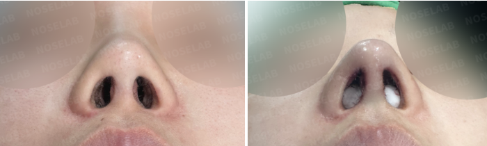 Nostril before and immediately after views showing reduced nostril exposure and improved columella position after short upturned nose revision rhinoplasty.