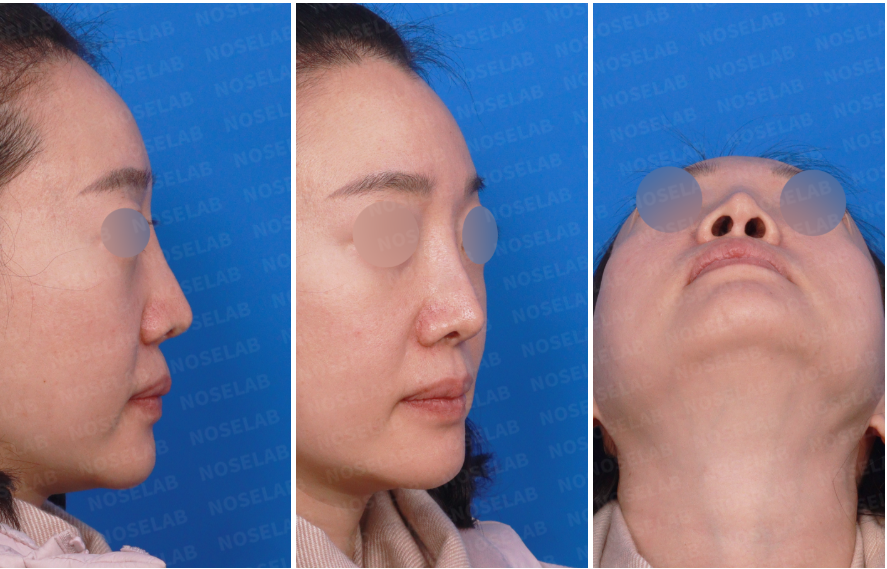 Preoperative views before autologous rib cartilage revision rhinoplasty showing side and nostril views