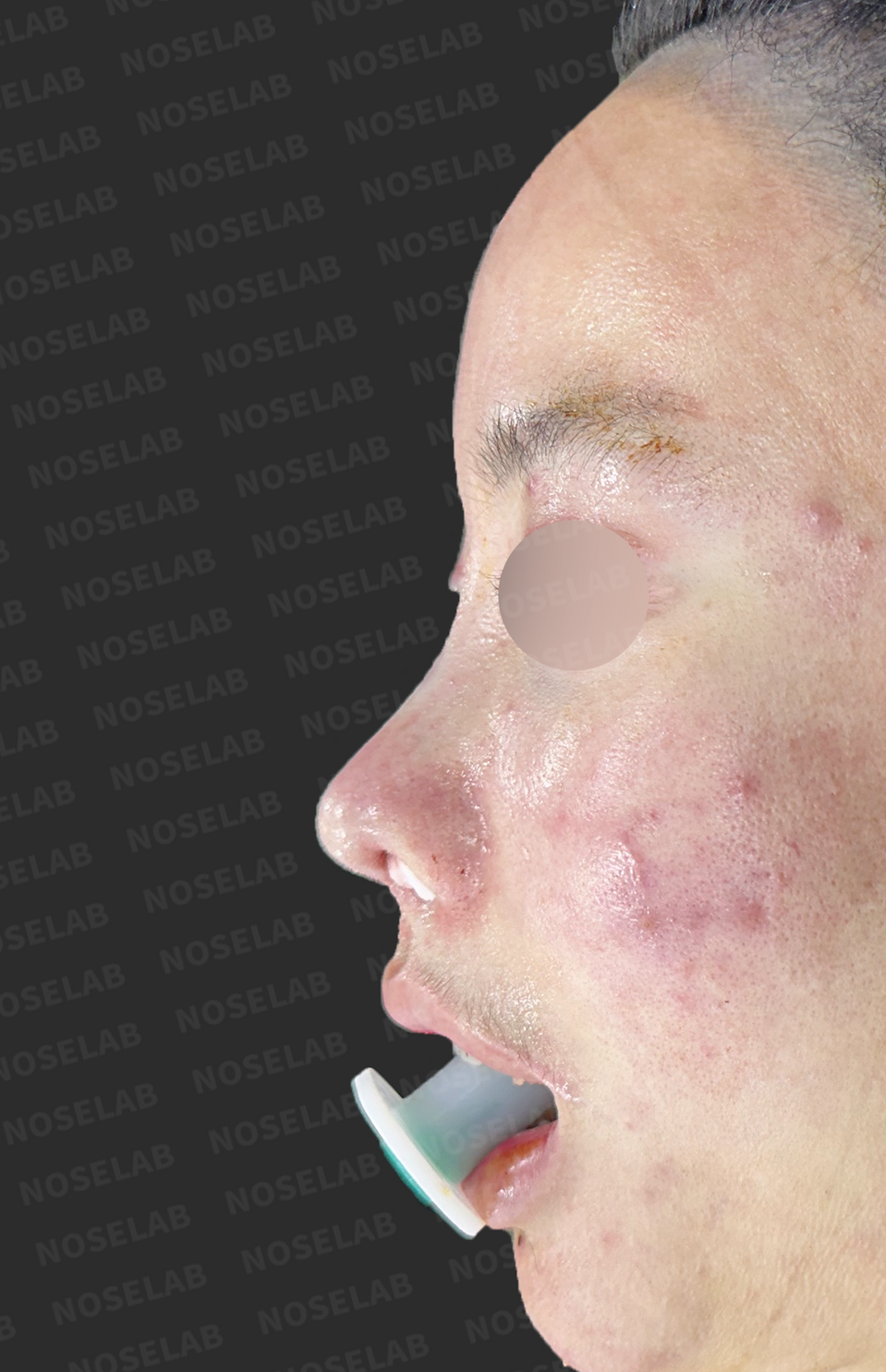 Immediately after surgery: left profile.