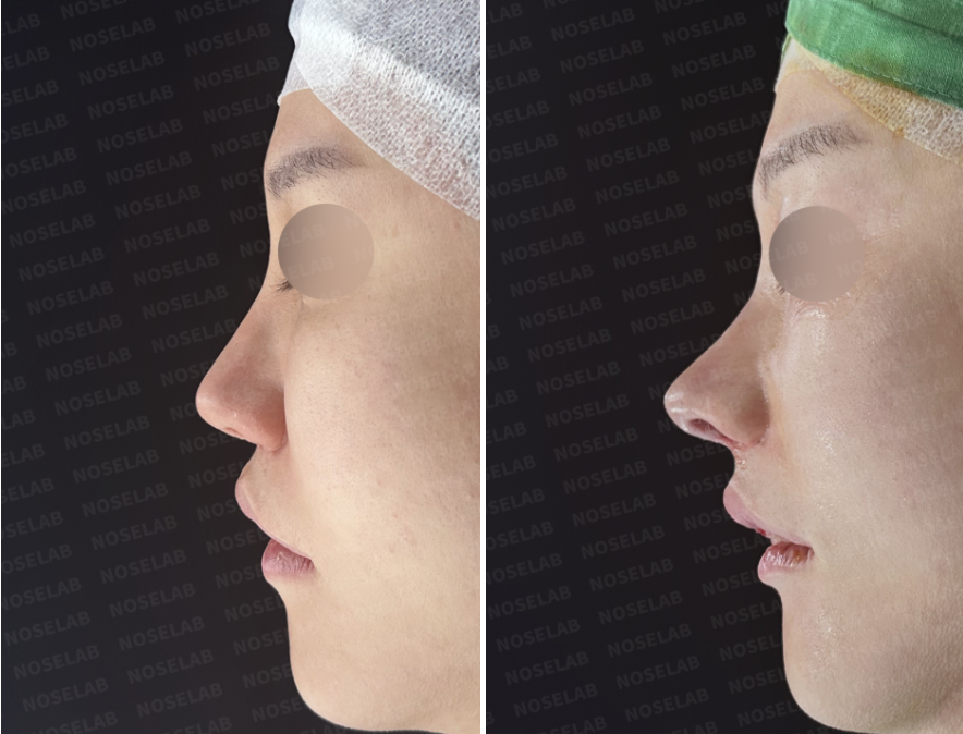 Before and immediately after surgery left side profile comparison showing improved nasal bridge contour and balanced nasal tip projection following revision rhinoplasty with structural reconstruction.