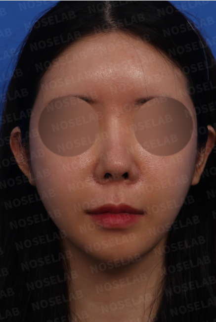 Revision rhinoplasty Korea – preoperative frontal view of upturned and deviated nose