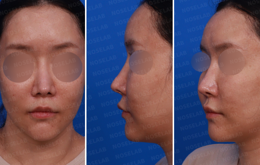 Design consultation photos before autologous rib cartilage rhinoplasty revision in Korea – frontal, left side, and oblique side views showing nasal deformity.