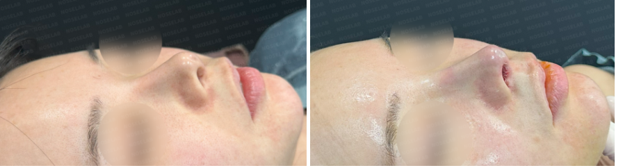 Before and after comparison – oblique side view of a patient before surgery (left) and immediate results after Revision Rhinoplasty Korea with closed approach (right), showing slimmer nasal bridge, refined tip, and improved facial balance.