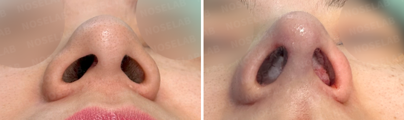 Nostrils before surgery (left), After surgery (right)