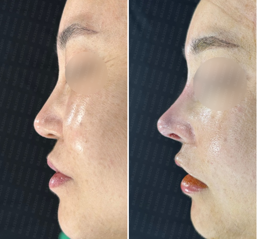 Side view before (left) and immediately after (right) nasal septum reconstruction surgery